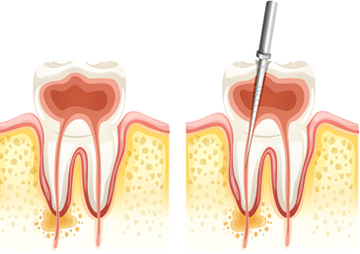 Root Canal Treatment